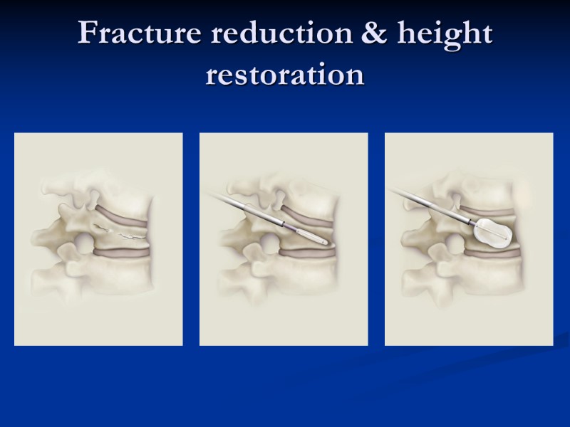 Fracture reduction & height restoration
